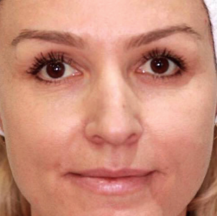 Lisa, 47 after using LED Esthetics