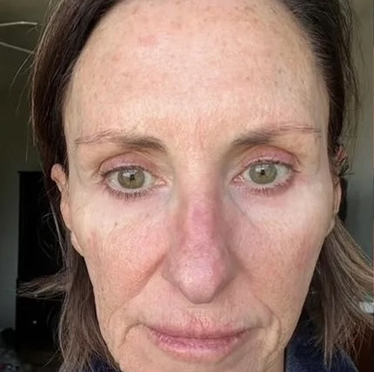 Tami, 61 before using LED Esthetics