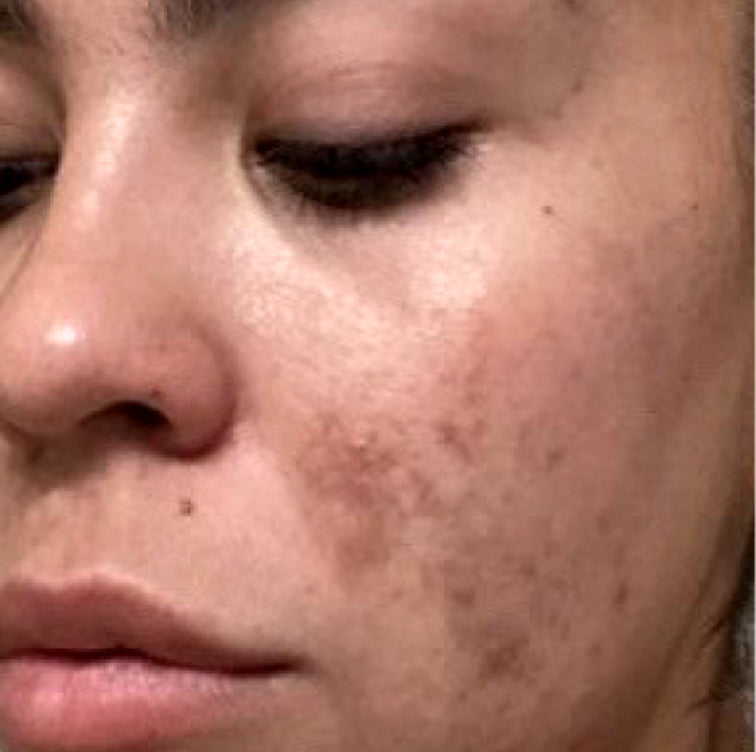 Adriana, 38 before using LED Esthetics