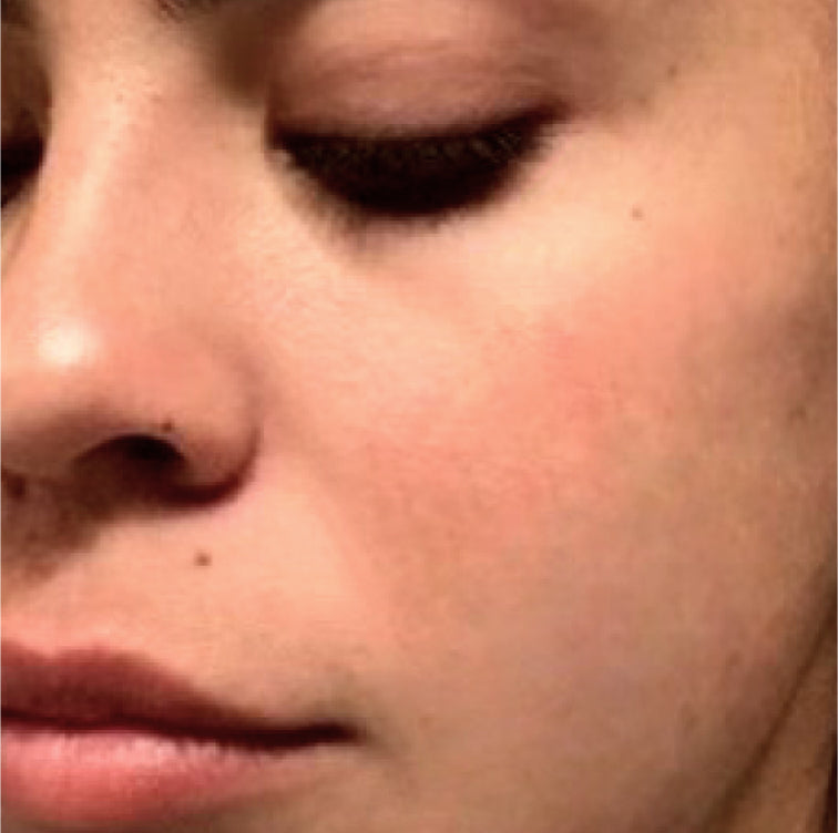 Adriana, 38 after using LED Esthetics