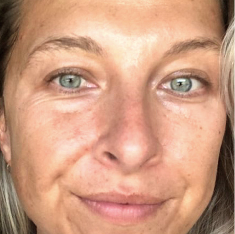 Karina, 39 before using LED Esthetics
