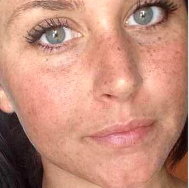 Amanda, 33 before using LED Esthetics