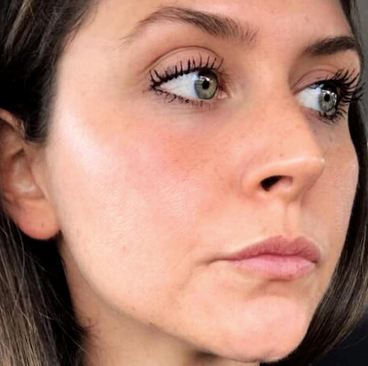 Amanda, 33 after using LED Esthetics