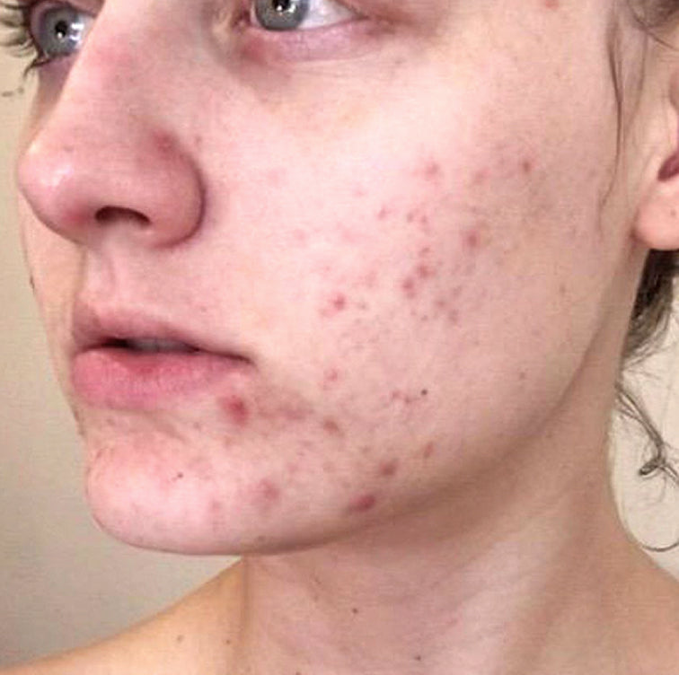 Iggie, 39 before using LED Esthetics