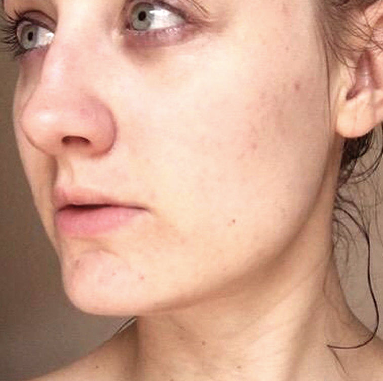 Iggie, 39 after using LED Esthetics
