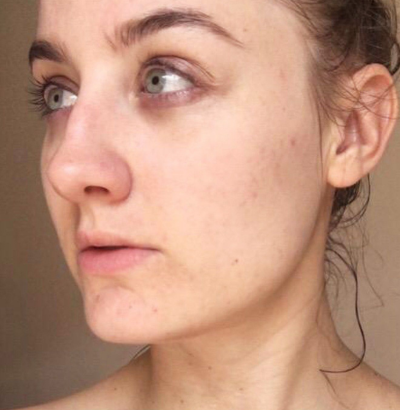 Client after using LED Esthetics