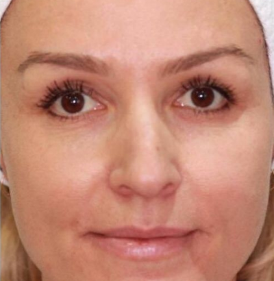 Client after using LED Esthetics