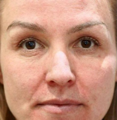 Client before using LED Esthetics