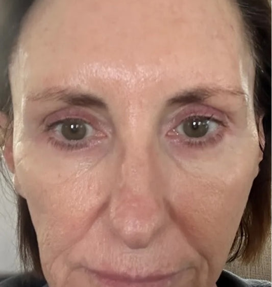 Tami, 61 after using LED Esthetics
