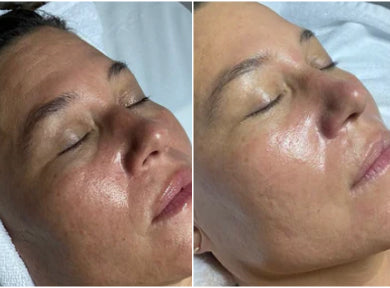 Before and after comparison of a woman's face with skincare treatment