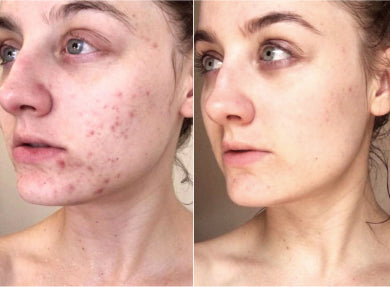 Before and after comparison of a person's face with acne on the left and clear skin on the right.