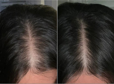 Before and after comparison of hair thickness on a person's scalp.