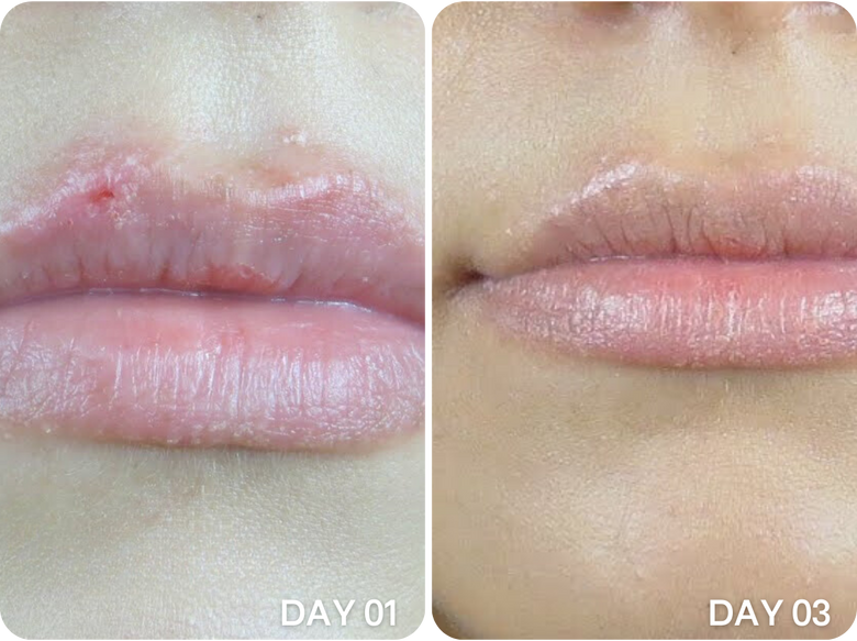 Dana, 41 before and after using No more cracked lips