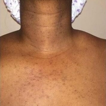 Grace, 46 before using LED Esthetics