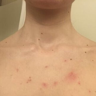Kelli, 29 before using LED Esthetics