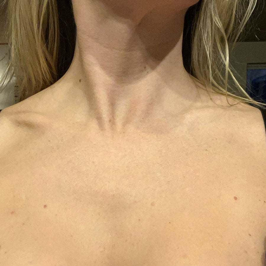 Veronica, 32 after using LED Esthetics
