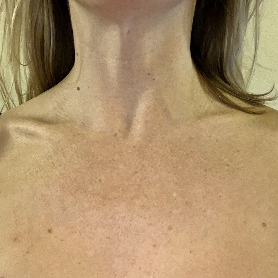 Veronica, 32 before using LED Esthetics