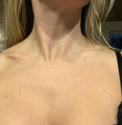 Client after using LED Esthetics