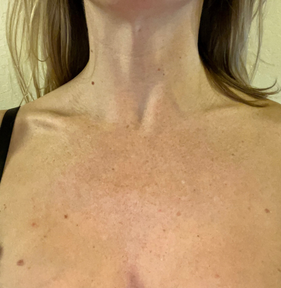 Client before using LED Esthetics