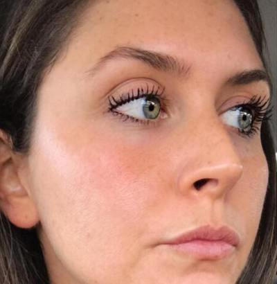 Client after using LED Esthetics