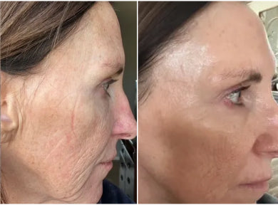 Before and after comparison of a woman's face with visible skin texture and aging.