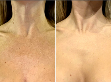 Veronica, 32 before and after using Sun damage gone!!