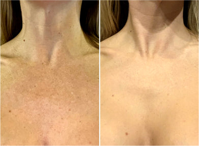 Before and after comparison of neck skin texture